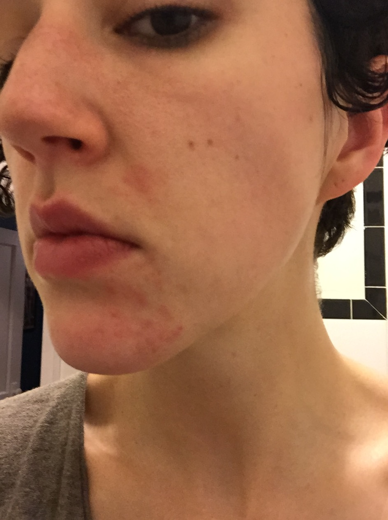 Illustration for article titled It Puts the ??? On Its Skin: Breaking Through My Breakouts